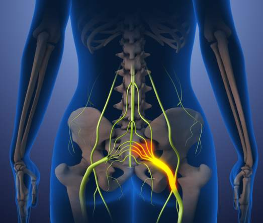 סכיאטיקה סכיאטיקה
