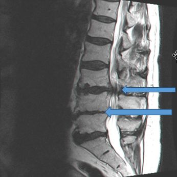 מצב של פריצת דיסק בעמוד השדרה