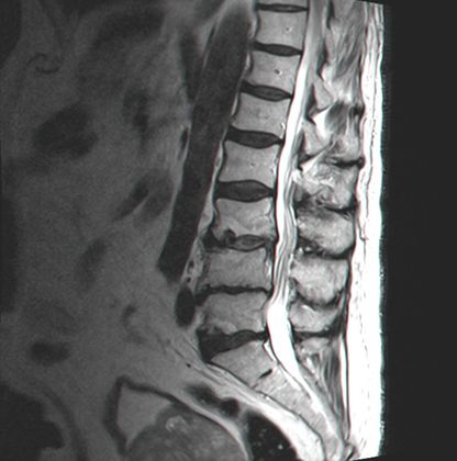 תוצאה לאחר ניתוח פריצת דיסק