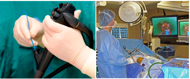 ניתוח פירצת ובקע דיסק בשיטה האנדוסקופית