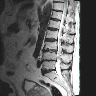 לאחר ניתוח עמוד שדרה מותני