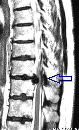לפני ניתוח פריצת דיסק לעמוד השדרה הטוראקאלי